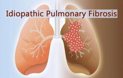 Pulmonary Fibrosis
