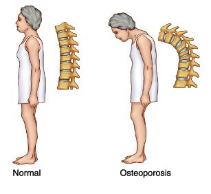 Osteoporosis