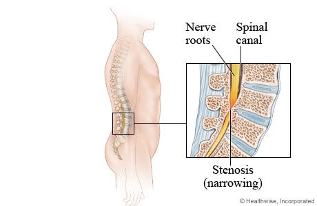 Spinal Stenosis