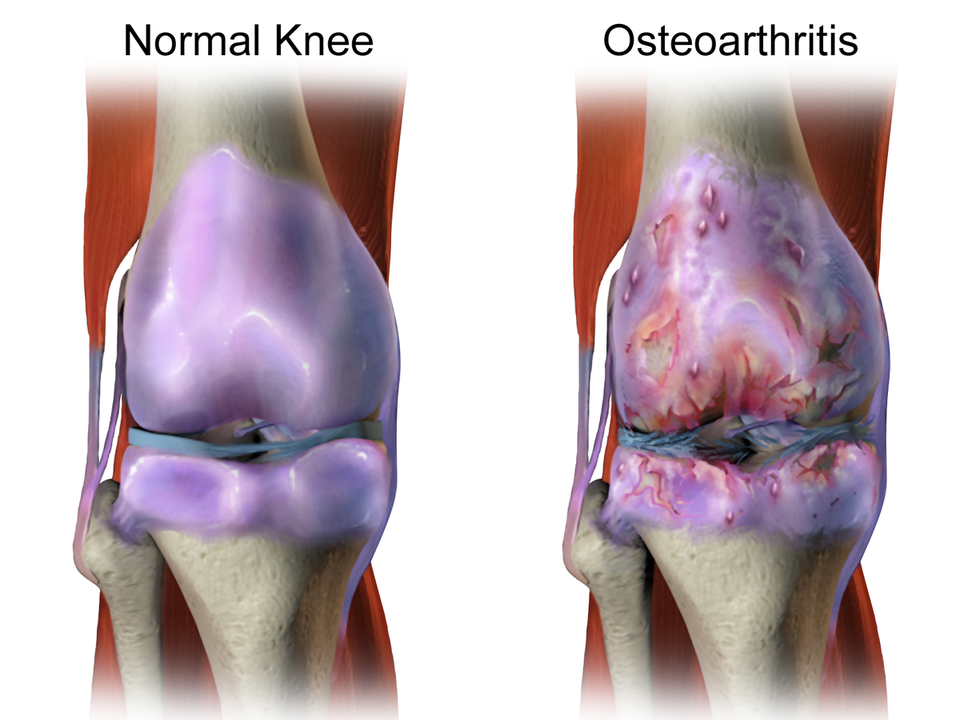 Knee Pain & Osteoarthritis
