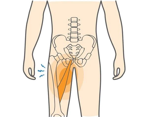 Groin & Hip Flexor Strain