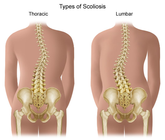 Scoliosis & Posture Disorders