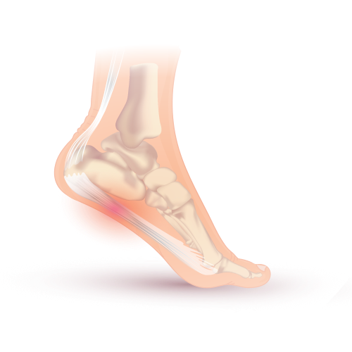 Plantar Fasciitis