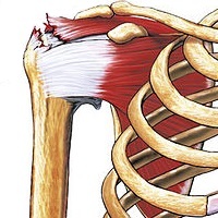 Rotator Cuff Injury