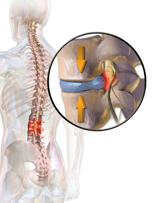 Sciatica & Disc Prolapse