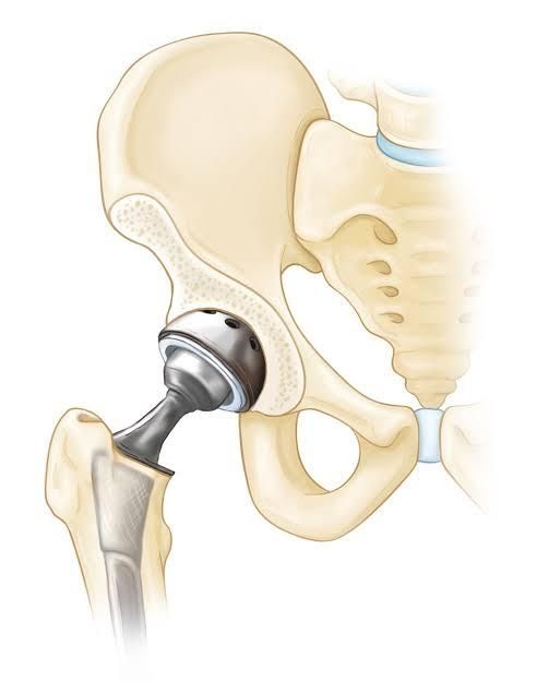 Hip Replacement Rehab