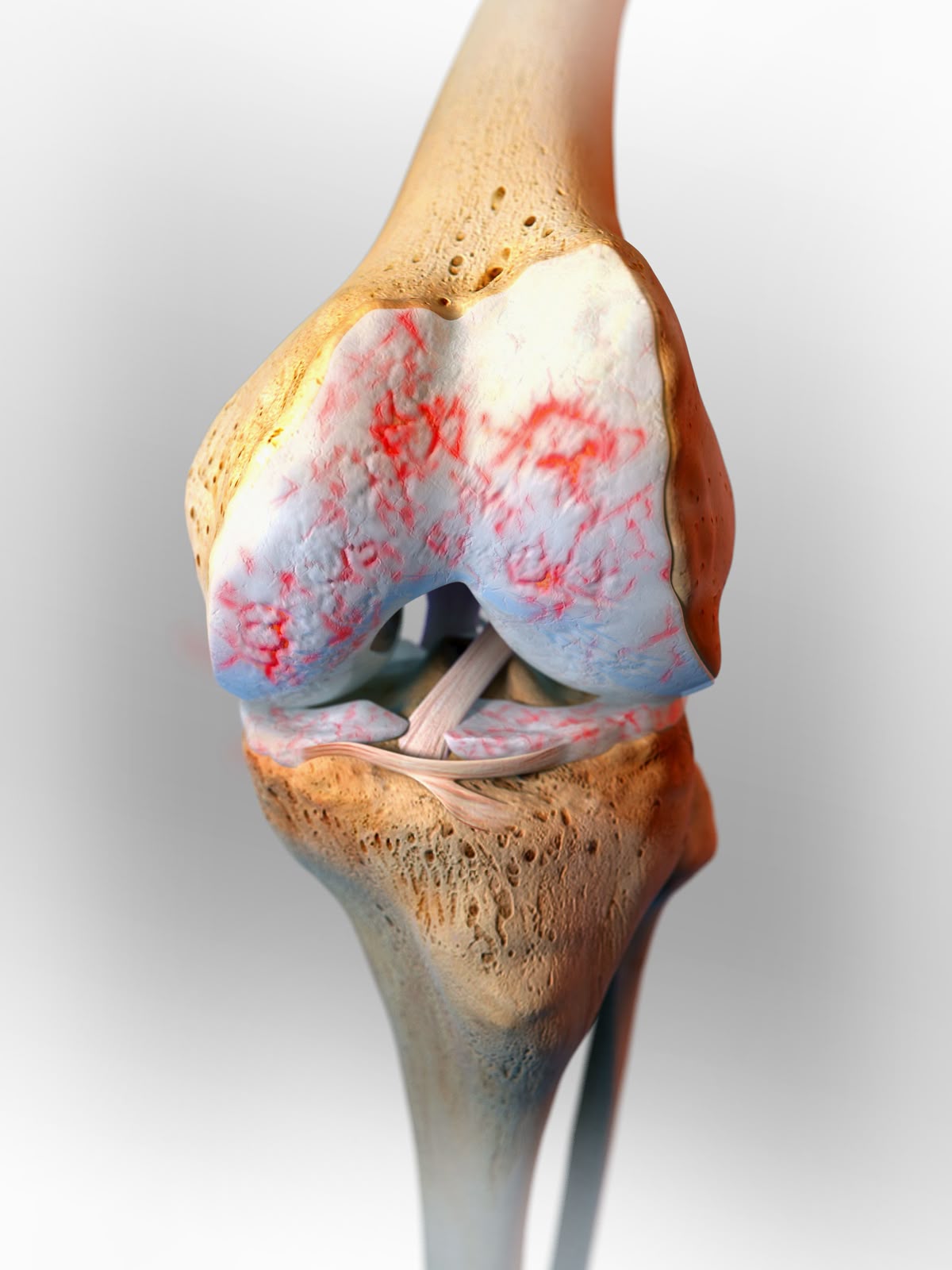 ACL / Meniscus Injury
