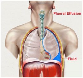 Pleural Effusion Recovery
