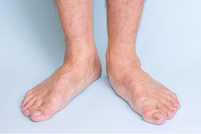 Flat Feet & Gait Issues